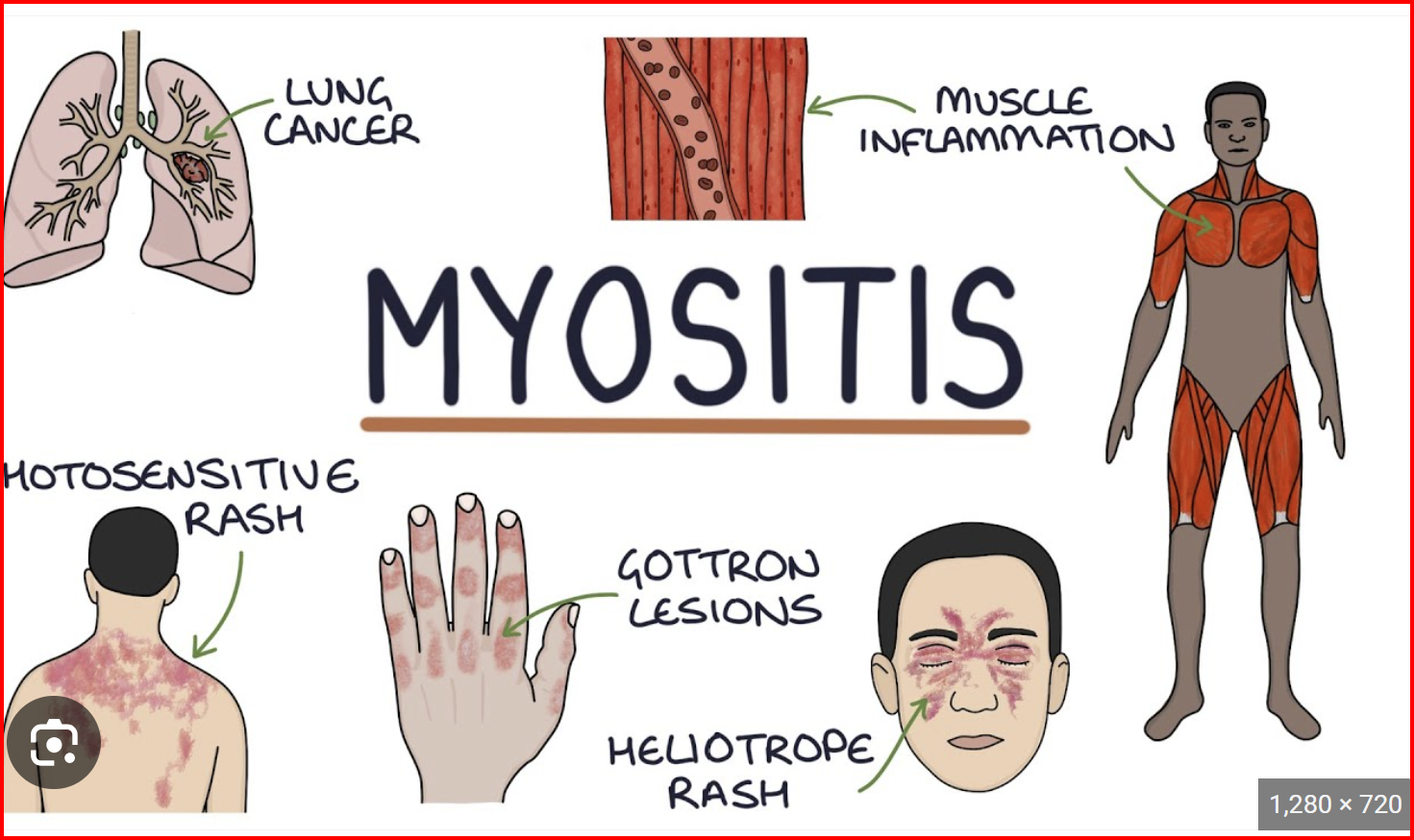 Autoimmune myositis — muscle inflammation illustration