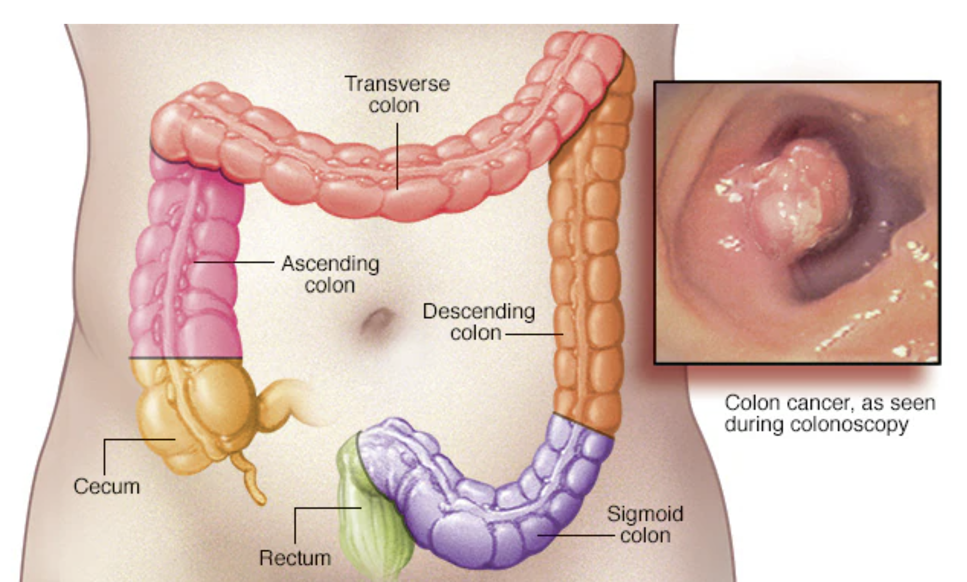 Colon cancer — colorectal health and nutrition