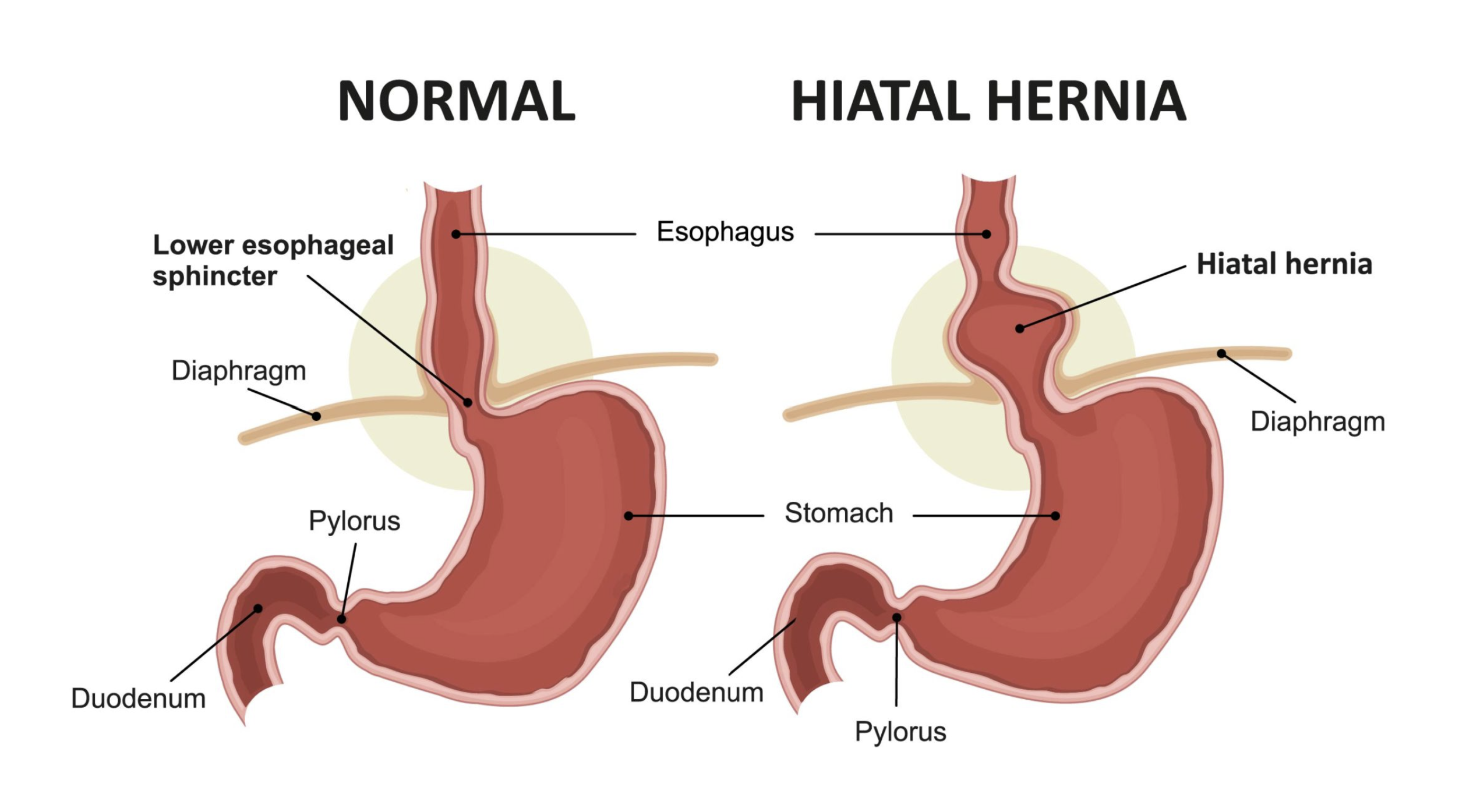 Hiatal hernia — digestive anatomy illustration