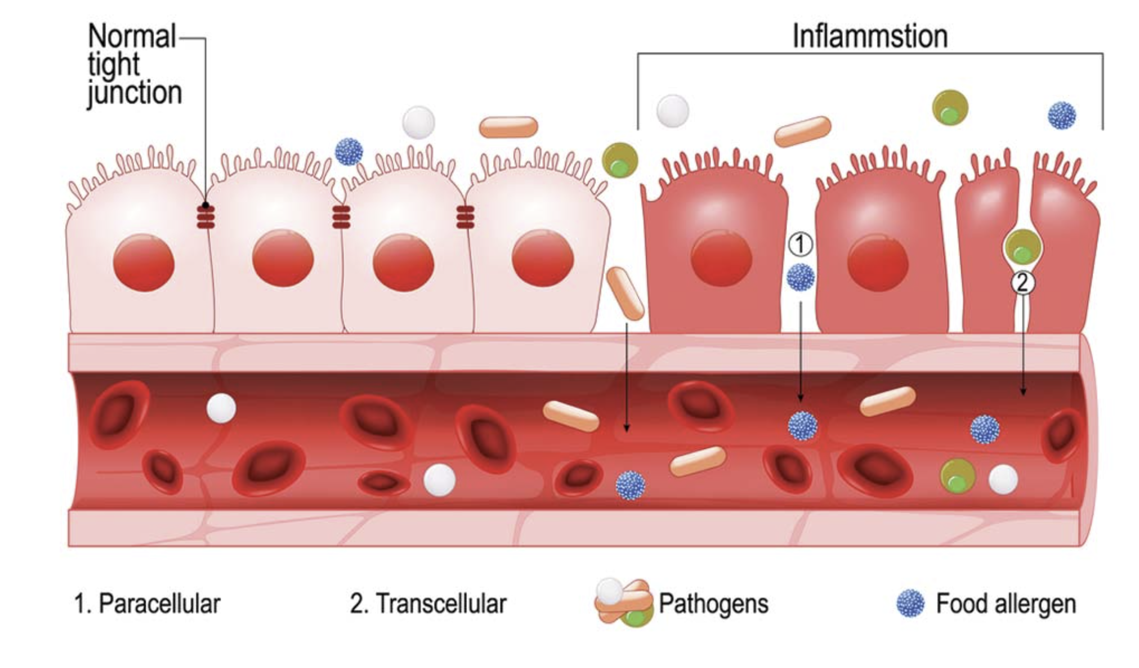 Leaky gut — intestinal permeability illustration